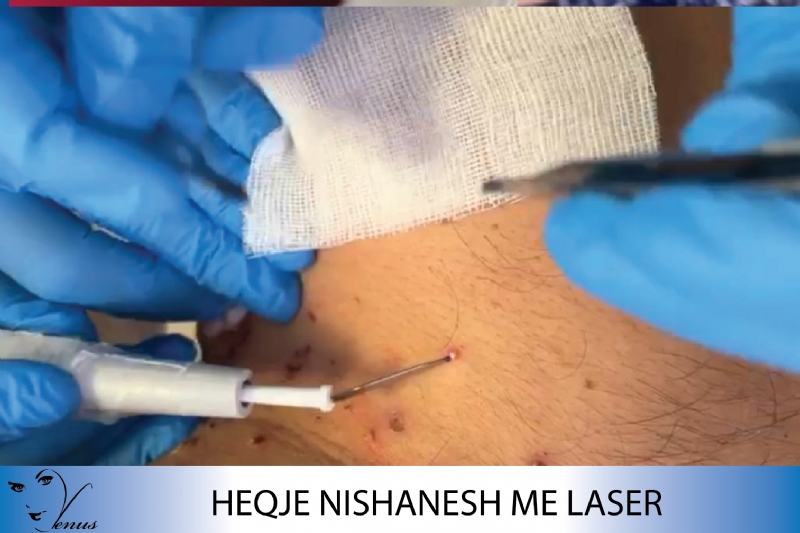 Ekzaminim i lekures me llampe wood, Diagnostikim nishaneve me dermatosko...