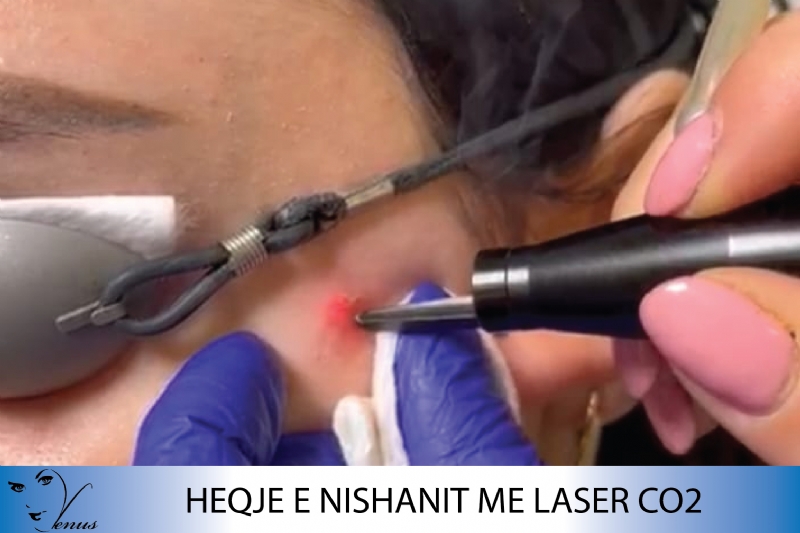 Heqje nishanit me Laser CO2, Heqje nishanesh me Laser, Heqje qimesh me L...