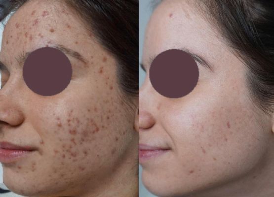 Klinika Dermatologjike Venus, Laser fraxional jo albativ 1450 nm per trajtimin e akneve, laser per shenjat e akneve, laser per rrudhat fine nga Dr Brunilda Bardhi